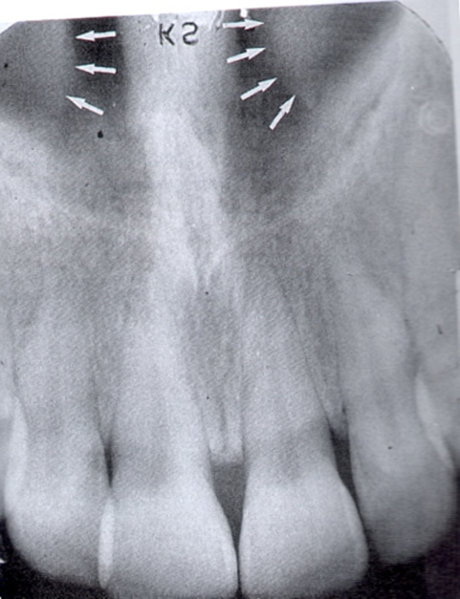 <p>What is the radiopaque structure seen here?</p>