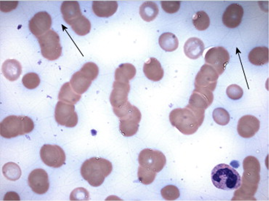 <p><span>cells partially adhering to each other, microscopically have the appearance of a stack of coins</span></p>