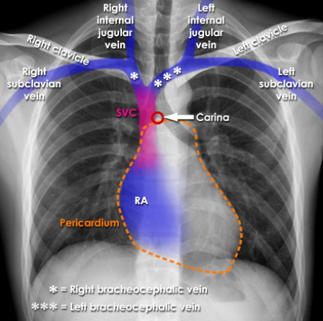 <p>Where are non-tunneled catheters typically inserted?</p>