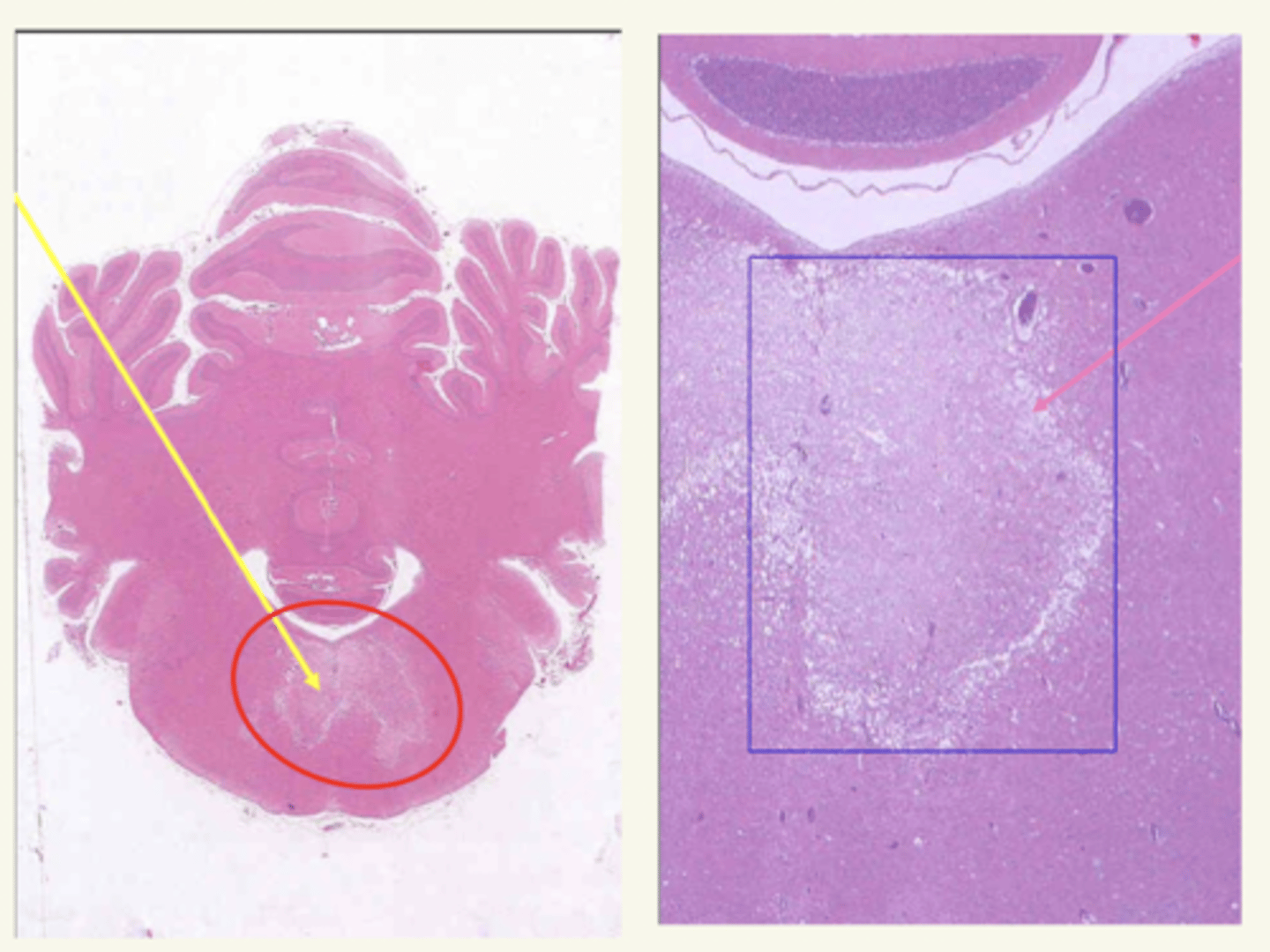 <p>áreas de necrosis bilateral, confluentes en la zona media del puente encefálico</p>