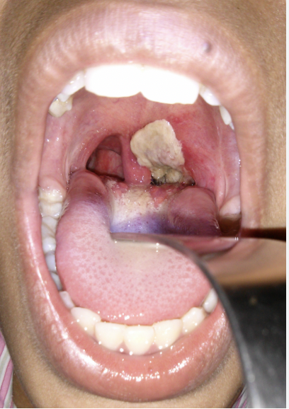 <p>Diptheria</p>