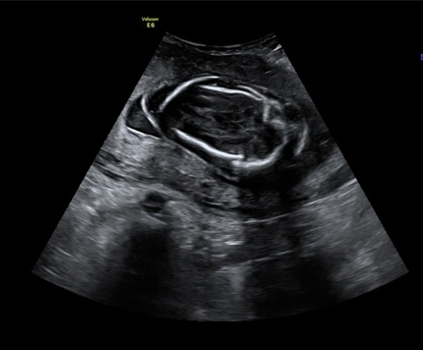 <p>Overlapping of cranial structures</p><p>Skull collapsing on itself</p>