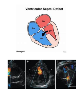 <ul><li><p>congenital and hereditary disease </p></li><li><p>small defect: potential for normal lifespan </p></li><li><p>large defect: </p><ul><li><p>stunted growth </p></li><li><p>poor exercise tolerance </p></li><li><p>murmur may be present </p></li><li><p>eventually signs of heart failure </p></li></ul></li><li><p>very large defect (&gt;1 inch): typically results in death within a minute of birth </p></li><li><p>diagnosis can be confirmed by ultrasonography, necropsy </p></li></ul><p></p>