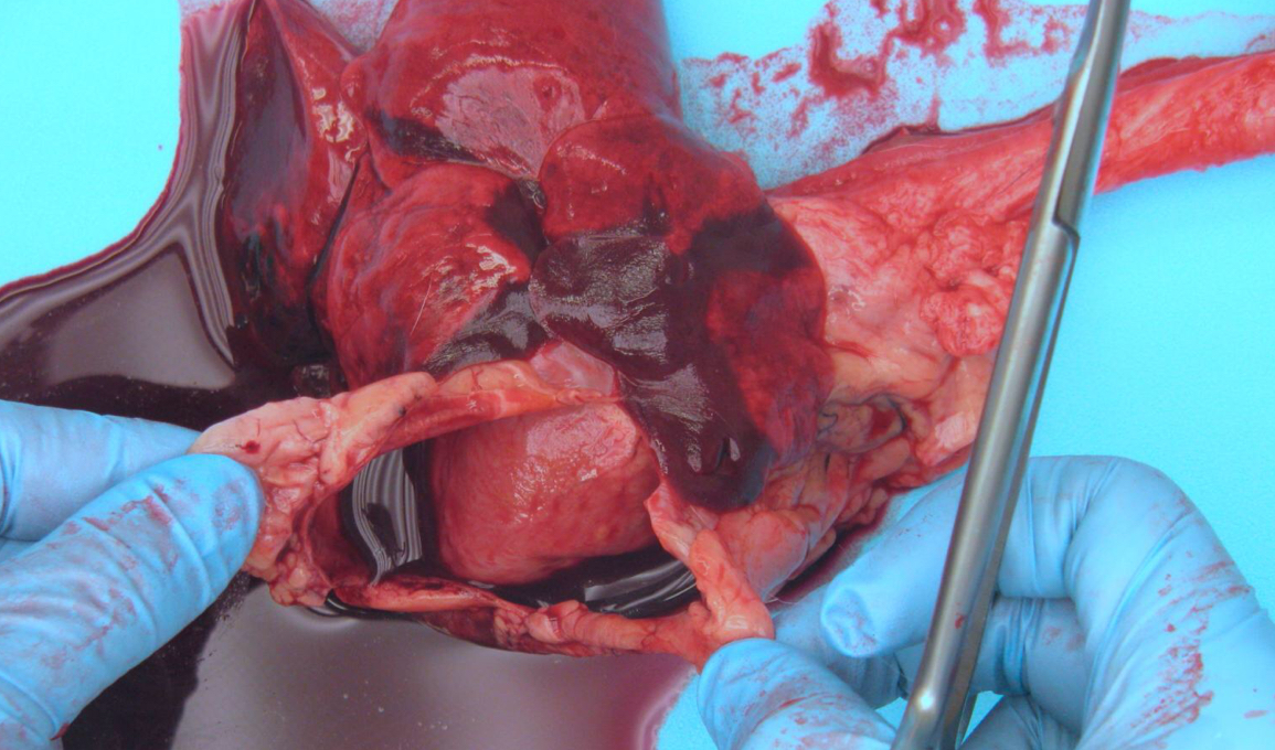 <ul><li><p>Compression of the heart due to accumulation of blood in the pericardial sac</p></li></ul><p></p>