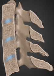 <p><strong><em>Seronegative spondyloarthropathy</em></strong> (RF negative) results in fusion of the spine and SI joints</p><p><strong><em>HLA B27</em></strong> is the gene with the strongest association</p><p>Radiographic features: “bamboo spine” appearance. Axial skeleton is predominantly affected. 20% of cases the peripheral joints are also involved.</p>