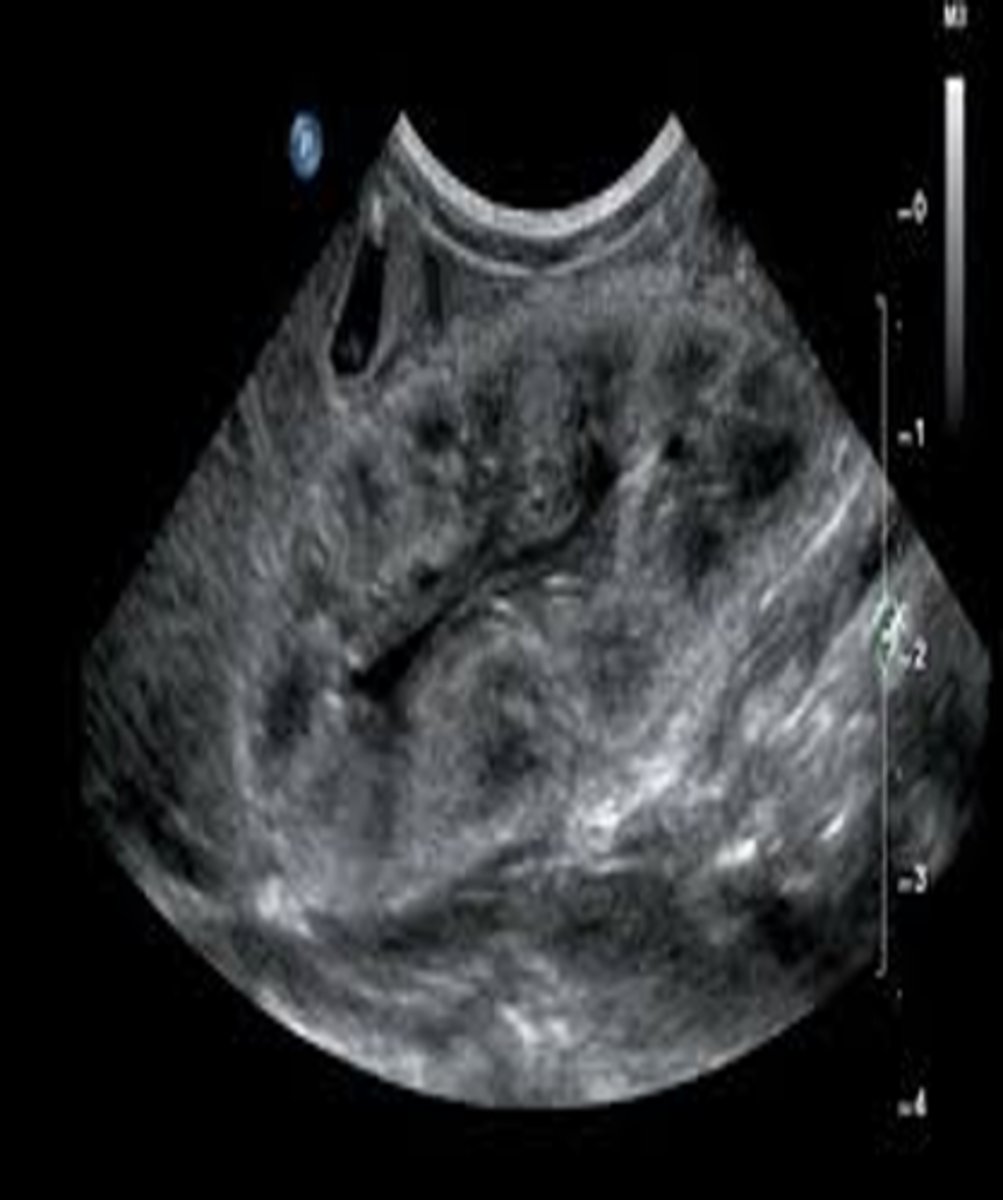 <p>autoimmune; hematuria; proteinuria; hypertension; thrombosis; insufficiency</p>