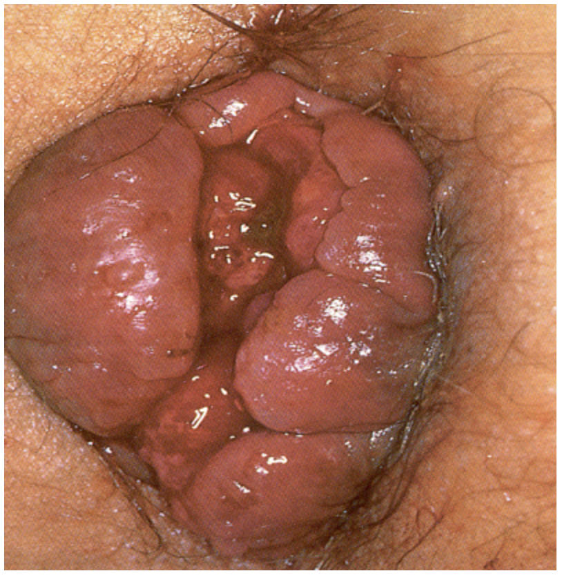 <p>36 y/o pregnant female presents to the clinic for rectal bleeding that has been going on the last few months. She also reports that its been itchy. During the DRE, when the patient bears down you note a hemorrhoid that passes the dentate line and is only reducible with manual pressure. What is your treatment plan - its recurrent?</p>