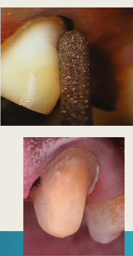 <ul><li><p>Thicker bur (large-radius rounded internal angle) giving 1-1.2 mm thickness  </p></li><li><p>Same as chamfer - 90 degree cavosurface angle</p></li></ul><p></p>