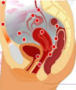 <p><strong>Endometriosis: Background</strong></p><p>-Endometrial glands and stroma that occur _______ the uterine cavity </p><p>-Lesions are typically located in the _____ but can occur at multiple sites like bowel, diaphragm, and pleural cavity </p><p>-This ___________-dependent, benign, ectopic endometrial tissue results in ____________ that can cause debilitating symptoms </p><ul><li><p>Dysmenorrhea, dyspareunia, chronic ____, and infertility </p></li></ul><p></p>