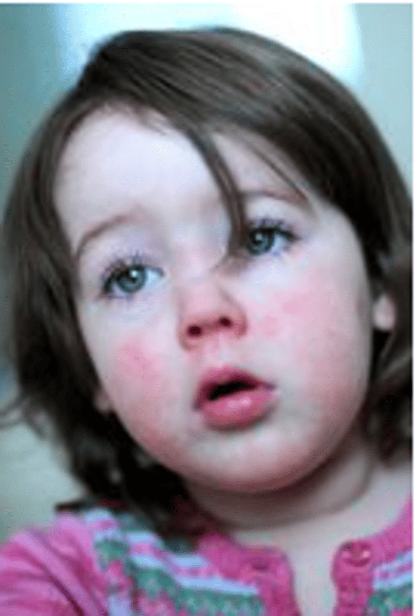 <p>______ is an acute illness characterized by a fever, sore throat, and bright red rashes on the body.</p>