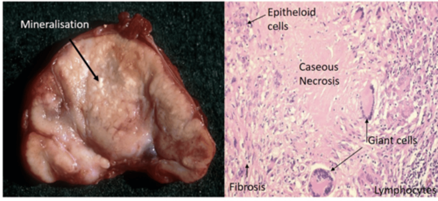 <p>Move to regional lymph node → Macrophage ingestion → Resist Macrophage destruction by producing Chord factor → protects mycobacterium from phagocytic killing especially from gamma interferon → Infected macrophages recruit other macrophages → Granulomatous inflammation that mineralises with age (Giant cells, Lymphocytes, epithelioid cells present)</p>