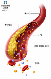 <ul><li><p>high LDL (cholesterol)</p></li><li><p>high TG</p></li></ul><p></p>