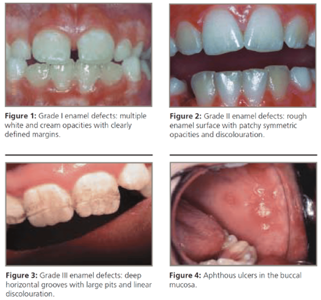 <p>Oral manifestations of this GI disease include:</p><p>• Enamel defects including hypoplasia, discoloration and banding</p><p>• Aphthous ulcers</p>