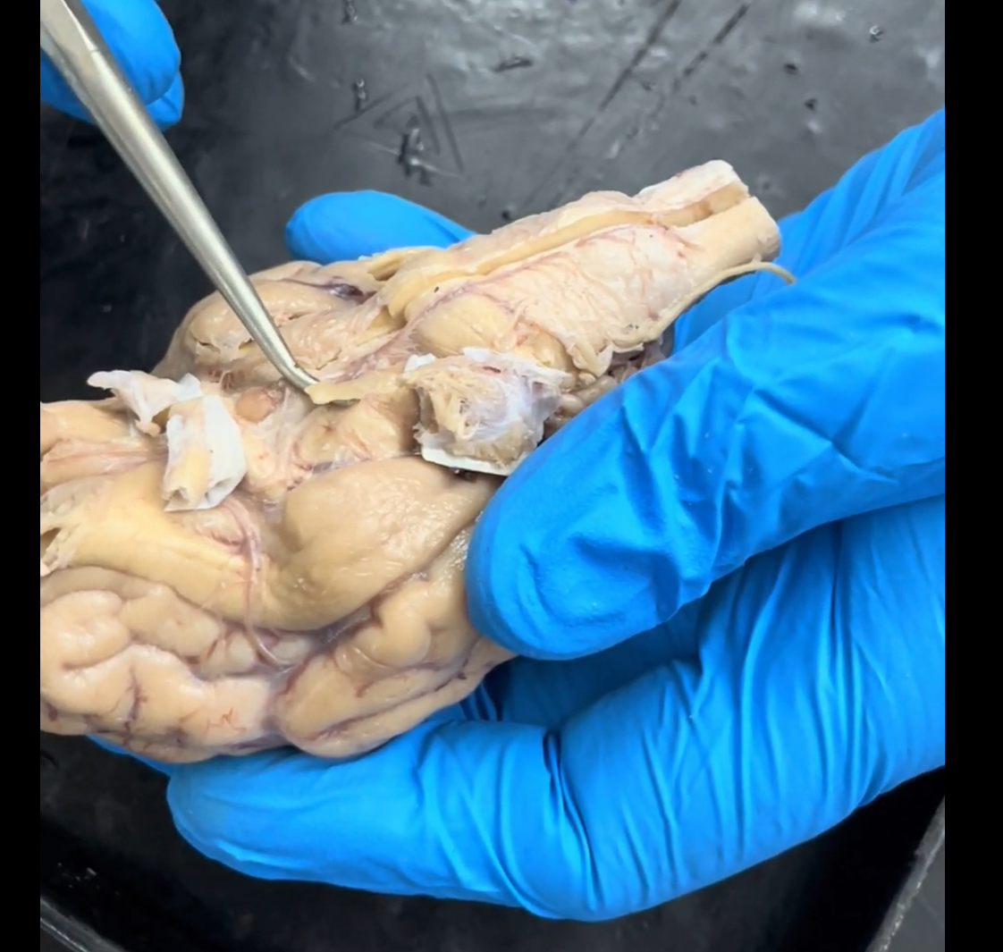 <p>Name the part of the brain being lifted by the probe.</p>