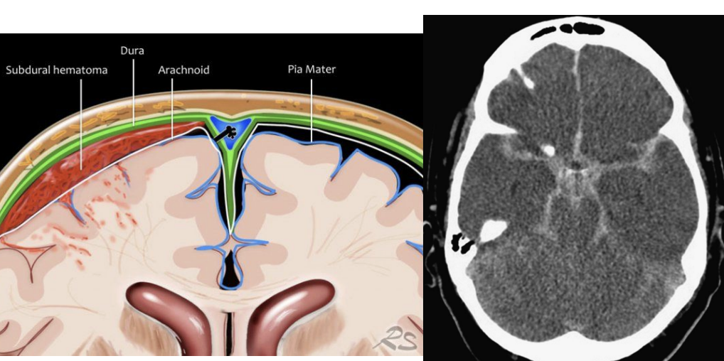 <p>Extracerebral Hemorrhages </p>