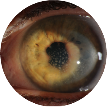<p>What is the patient likely suffering from?</p><ul><li><p>The patient is experiencing sudden pain, watering, and redness of the eye</p></li><li><p>The patient also has lupus</p></li><li><p>The patient is feeling very light sensitive and has slightly reduced vision in the affected eye</p></li><li><p>On slit lamp examination, the following can be observed: corneal precipitates, iris nodules, cells and flare inside the aqueous, and <strong>synechiae</strong> (the iris is stuck to the lens)</p></li><li><p>The vessels at the limbus are red and inflamed</p></li><li><p>The patient reports nausea</p></li><li><p>On tonometry, the IOP is elevated</p></li></ul><p></p>