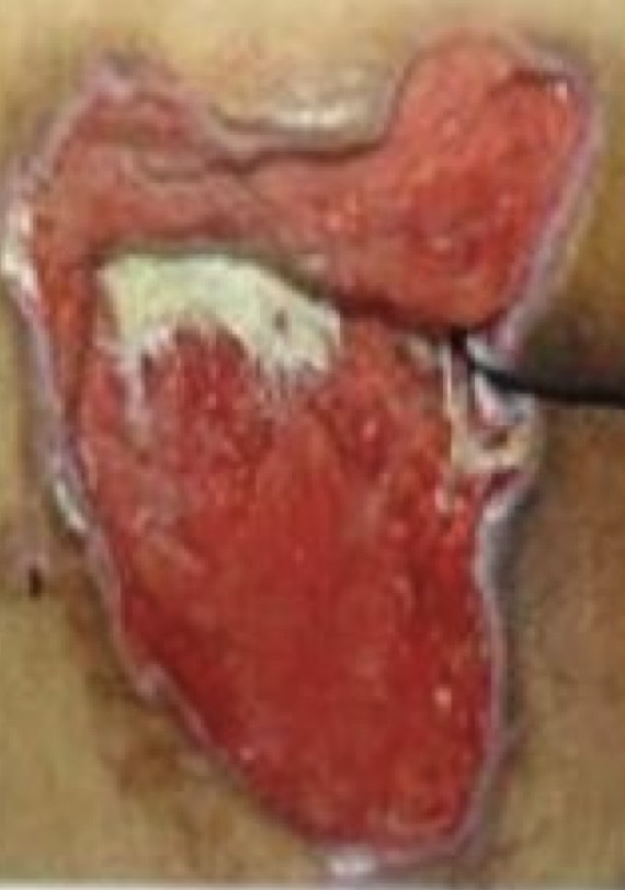 <p>Full-thickness tissue loss, where subcutaneous fat can be seen</p><p>Undermining and tunneling may occur</p><p>May be slough or eschar</p>