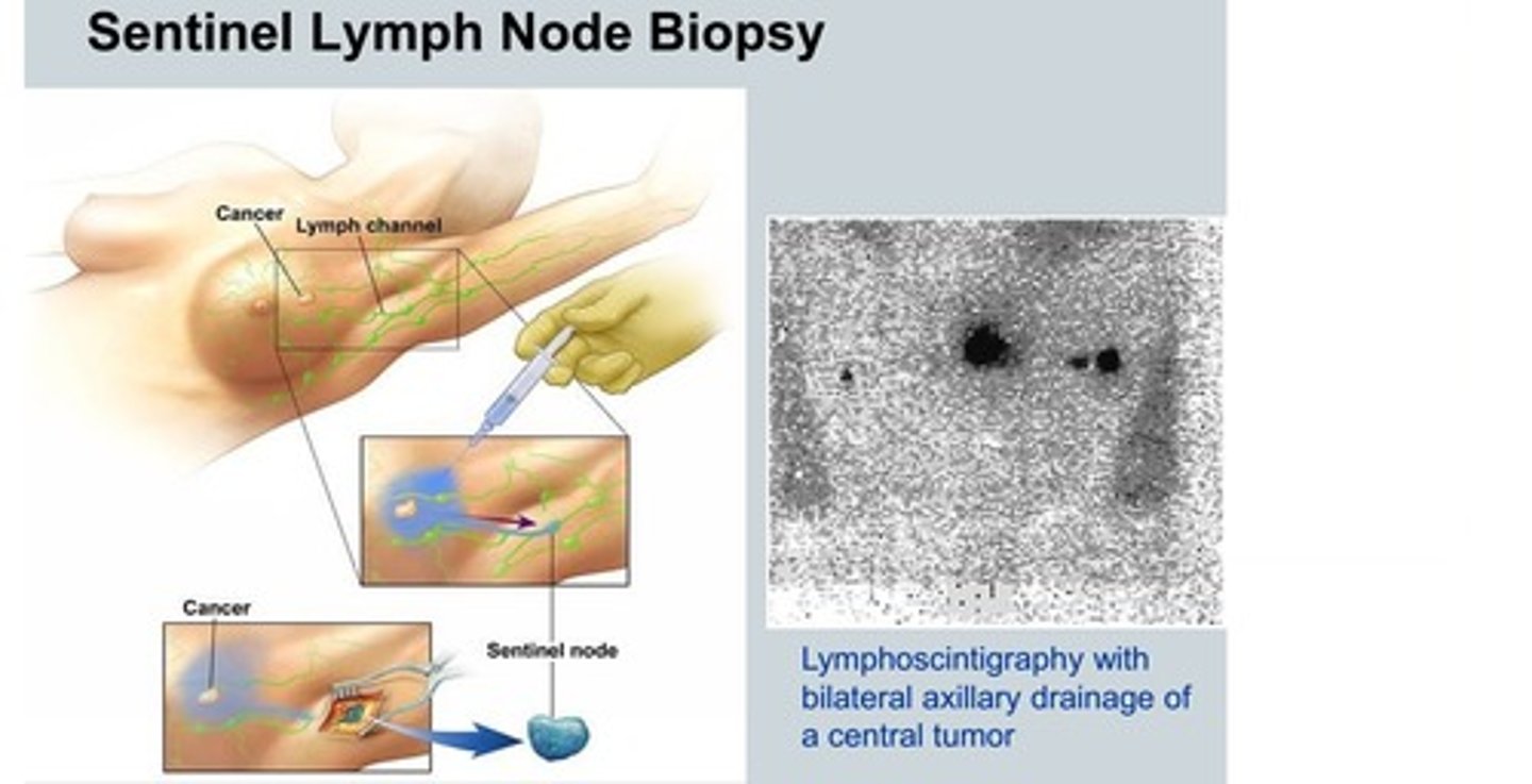 <p>injection of blue dye and/ or radioactive isotope used to identify the sentinel lymph node and most likely to contain metastasis of breast cancer</p>