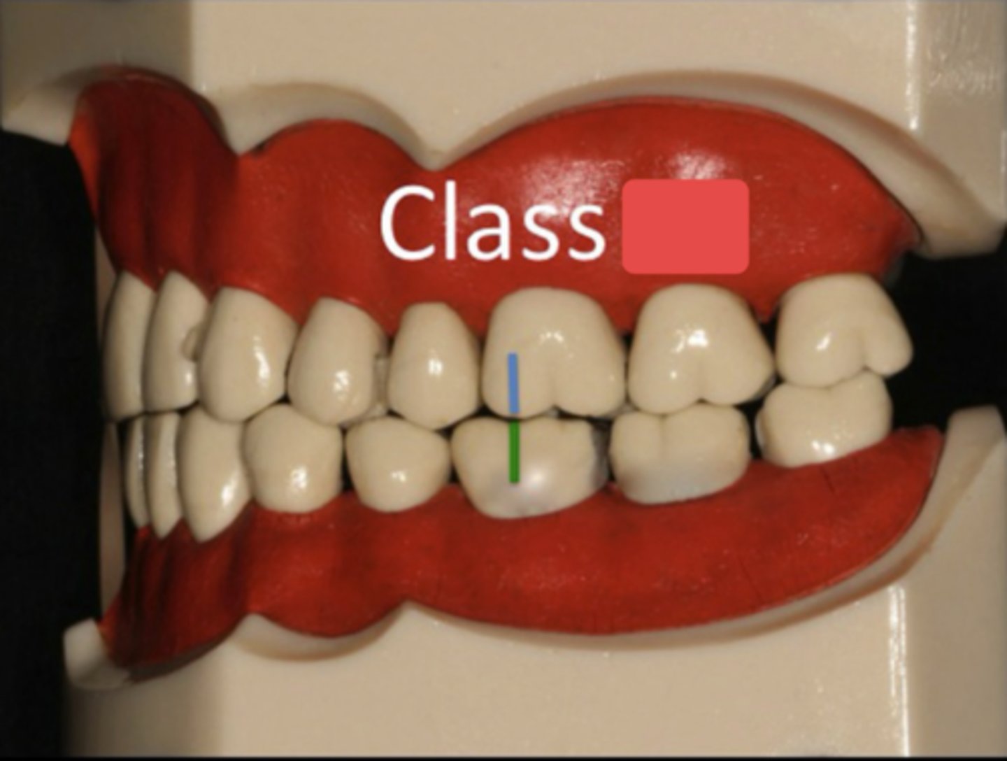 <p>ID the occlusion classification:</p>