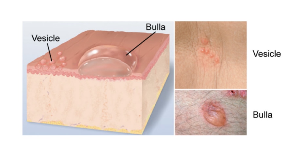 <p>Vesicle: elevated cavity containing free fluid (herpes simplex, chickenpox, herpes zoster) </p><p>Bulla: thin-walled, ruptures easily (friction blister, burns) </p>