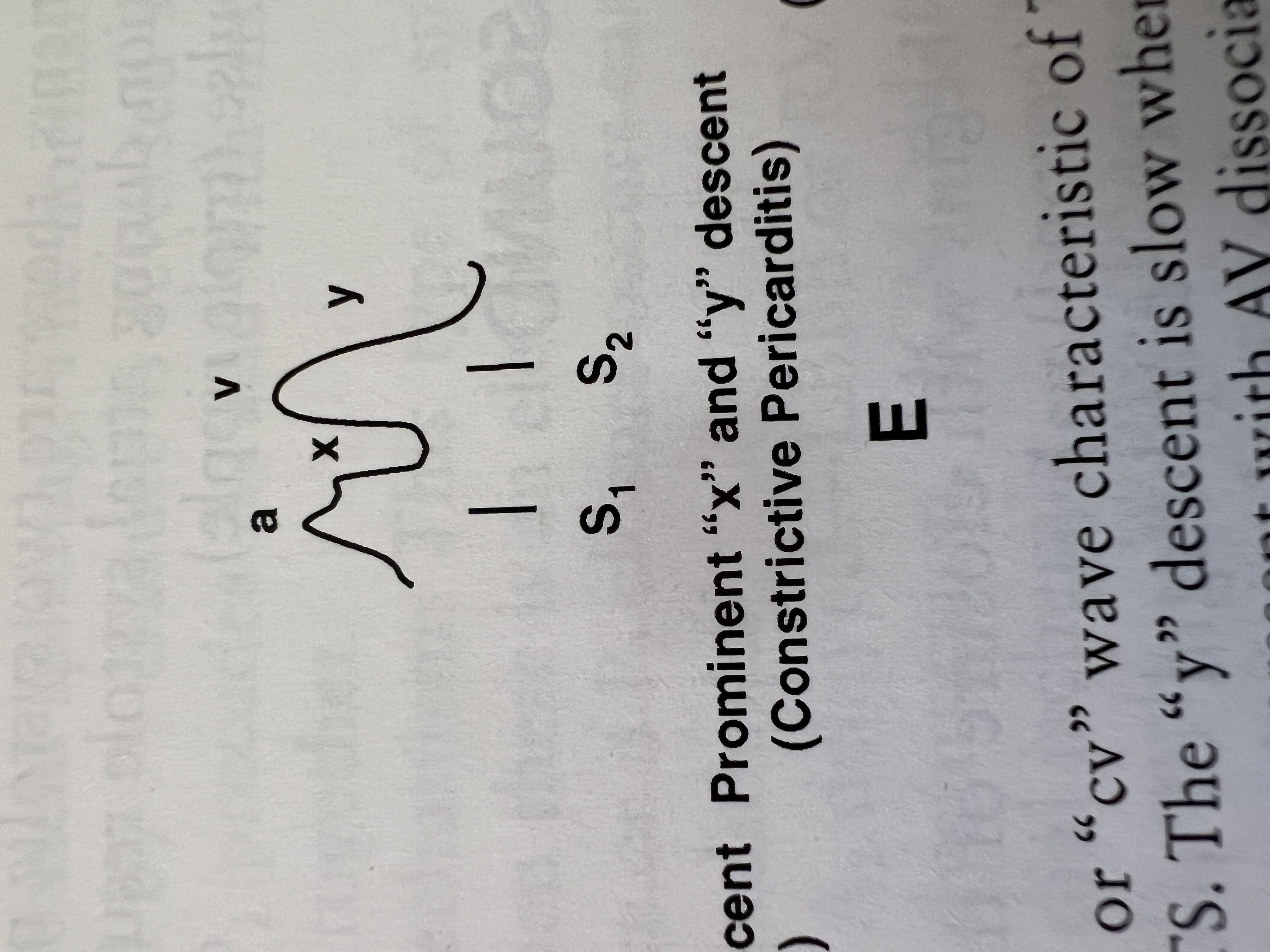 <p>Which condition presents with prominent 'x' and 'y' descents as a marker of early rapid filling?</p>