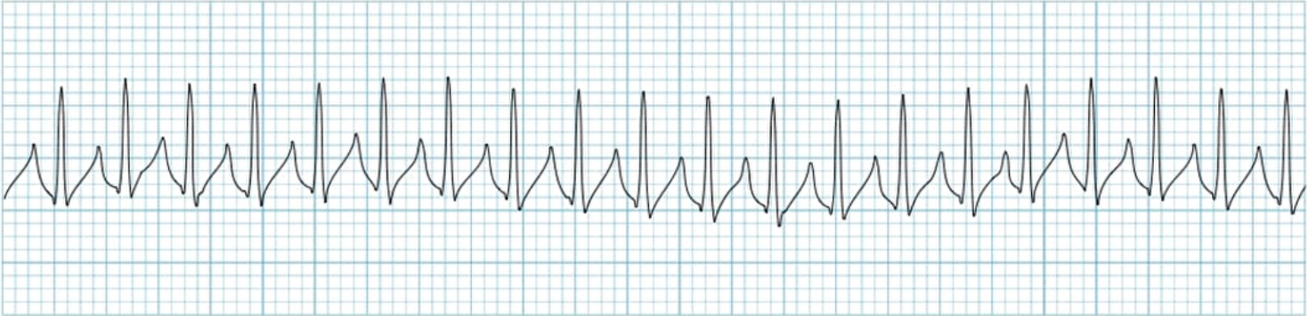<p>What does this EKG represent?</p>