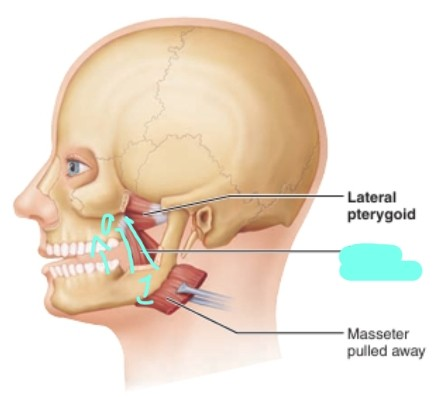 <p>medial pterygoid muscle</p>
