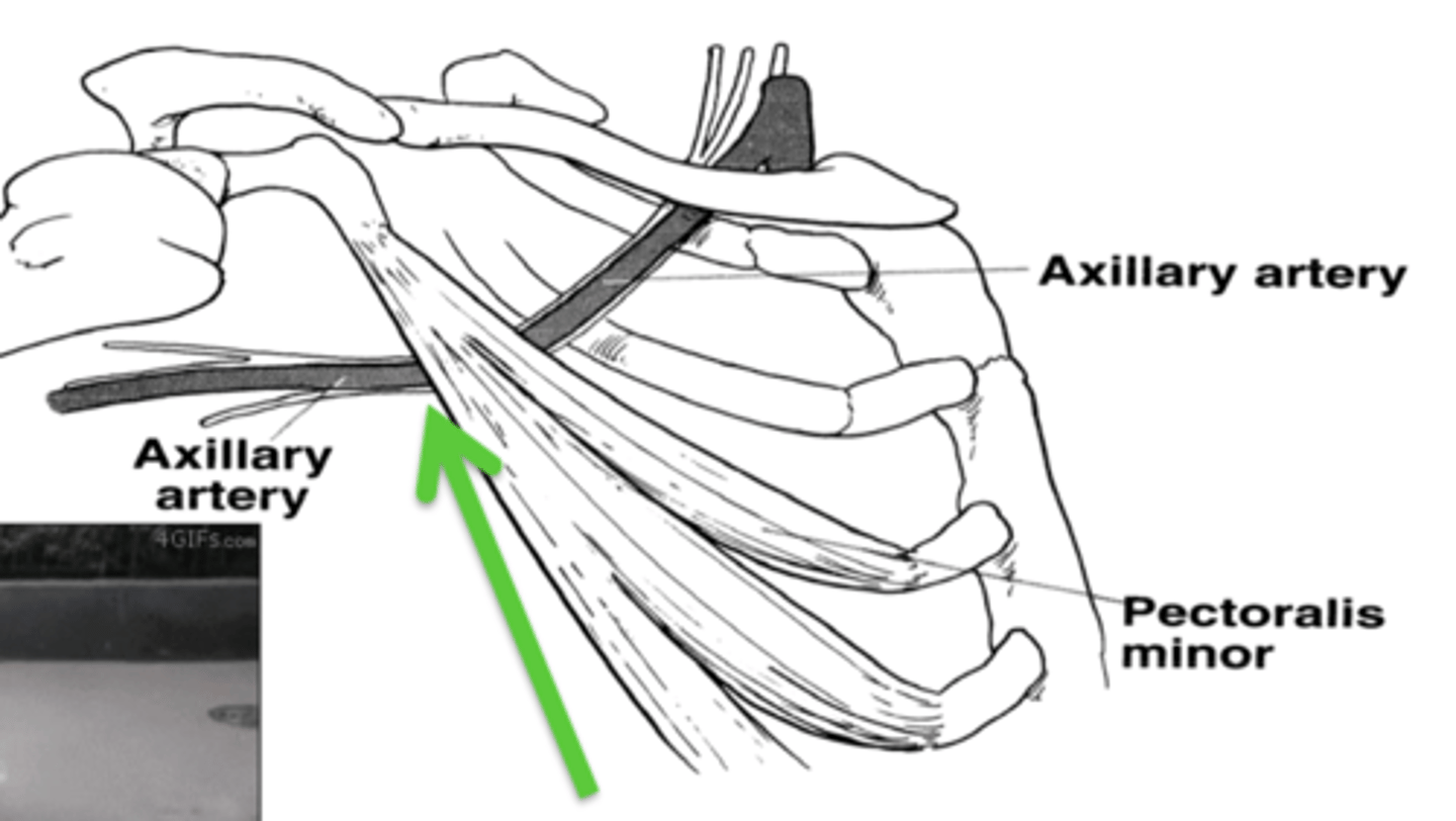 <p>- anterior: pec minor</p><p>- posterior: chest wall</p>