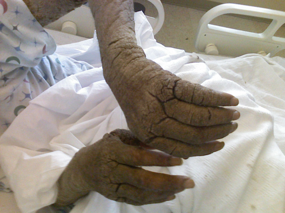 <p>Scabies in immunocompromised patients e.g. HIV</p>
