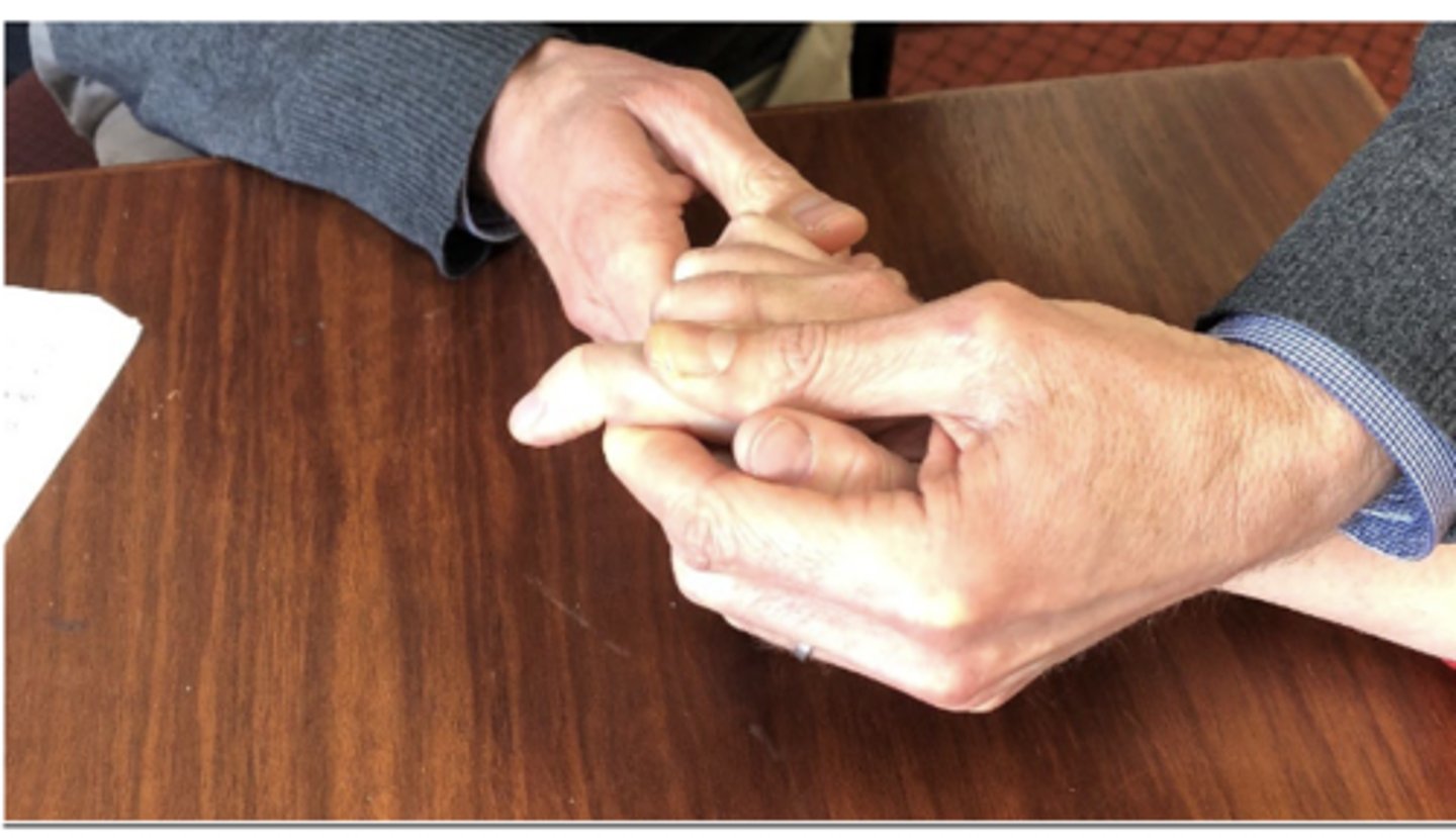 <p>- diagnosis: injury to extensor tendons</p><p>- how: isolate extensor tendon by holding finger at middle phalanx, instruct patient to actively extend DIP joint</p><p>+ = unable to extend DIP joint</p>