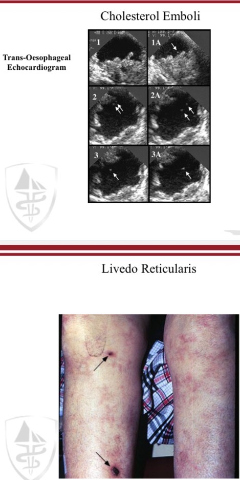 <ul><li><p>Livedo reticularis (skin)</p></li><li><p>Eosinophiluria (Eosinophiluria)</p></li></ul><p></p>