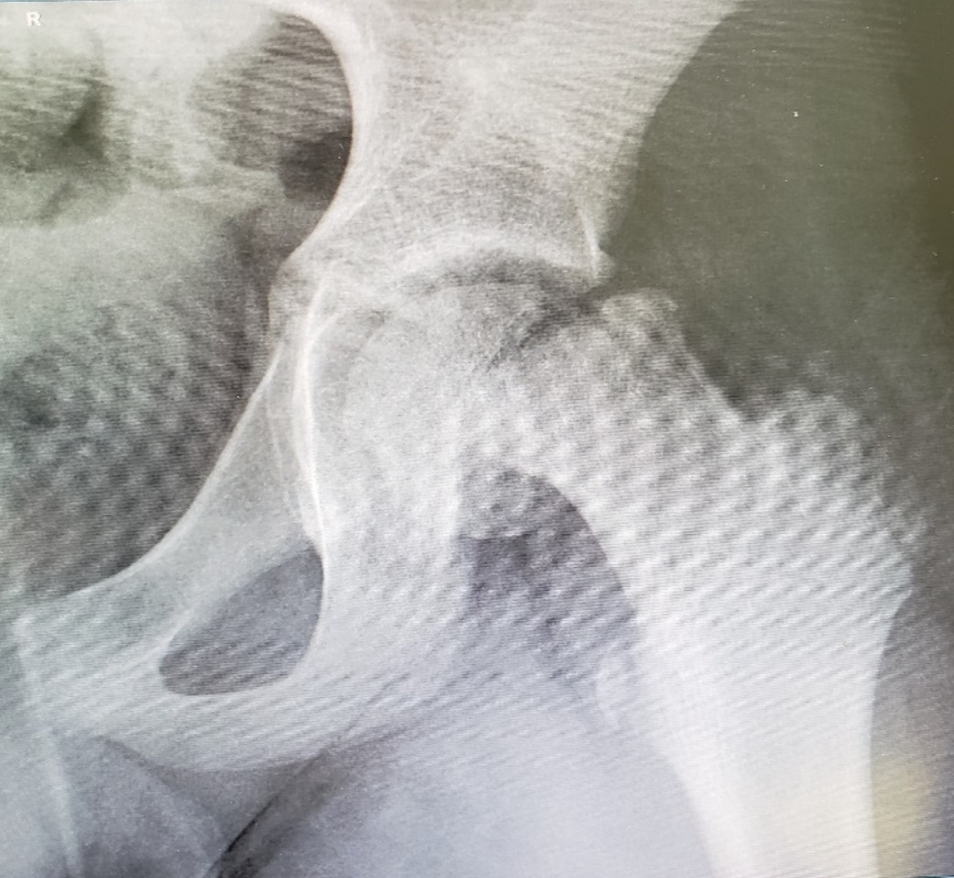 <p>it is when the <span><span>femoral head slips off neck of femur</span></span></p><ul><li><p><span><span>happens more in the adolescent and growth spurt years</span></span></p></li></ul><p></p>