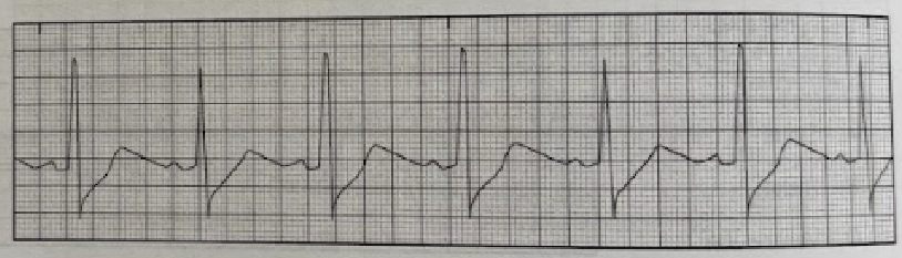 <p>Which of the following is shown on the EKG tracing?</p><p>A. Ischemia</p><p>B. Heart block</p><p>C. Junctional rhythm</p><p>D. Wandering atrial pacemaker</p>