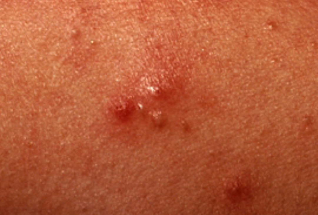 <p>Pustule</p>