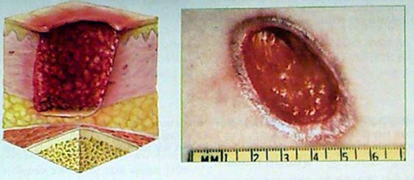 <p>secondary lesion; open lesion on skin, accompanied by loss of skin depth and possible weeping of fluids or pus</p>