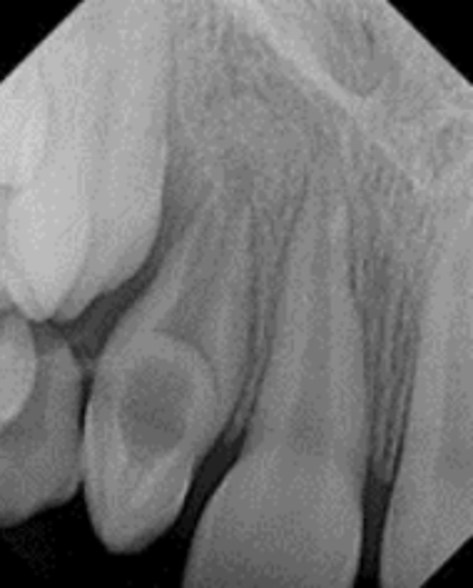 <p>what condition is found in this image?</p>