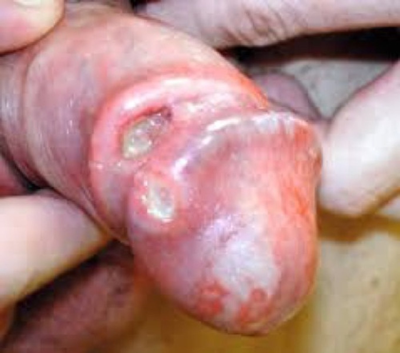 <p>Penile skin abnormality/palpable mass (painless lump/ulceration, rash, bleeding, balanitis, etc.) inguinal LAD</p>