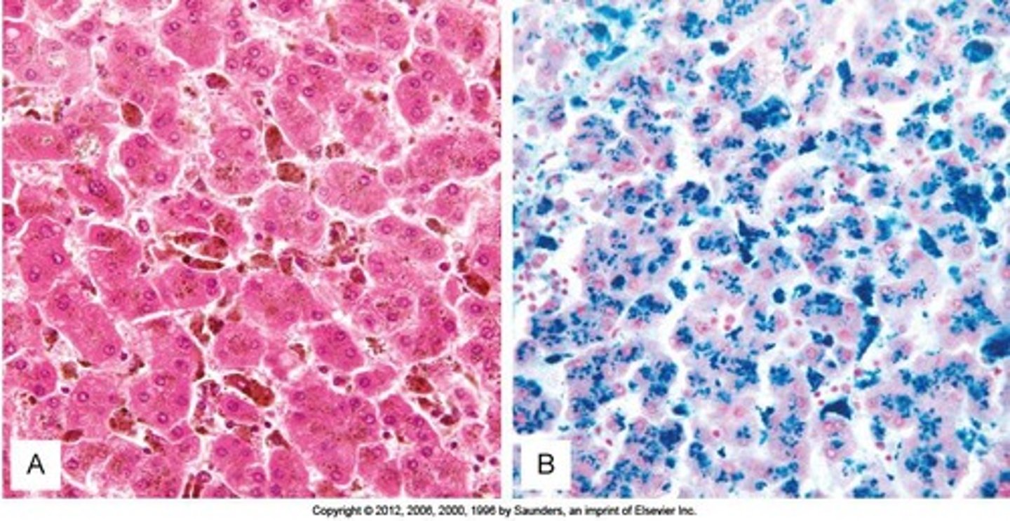 <p>A condition characterized by the accumulation of fat in liver cells, often due to alcohol abuse or metabolic disorders.</p>