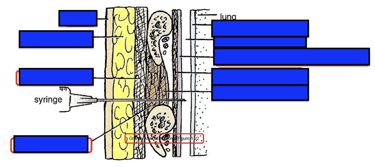 <p>Thoracentesis</p>