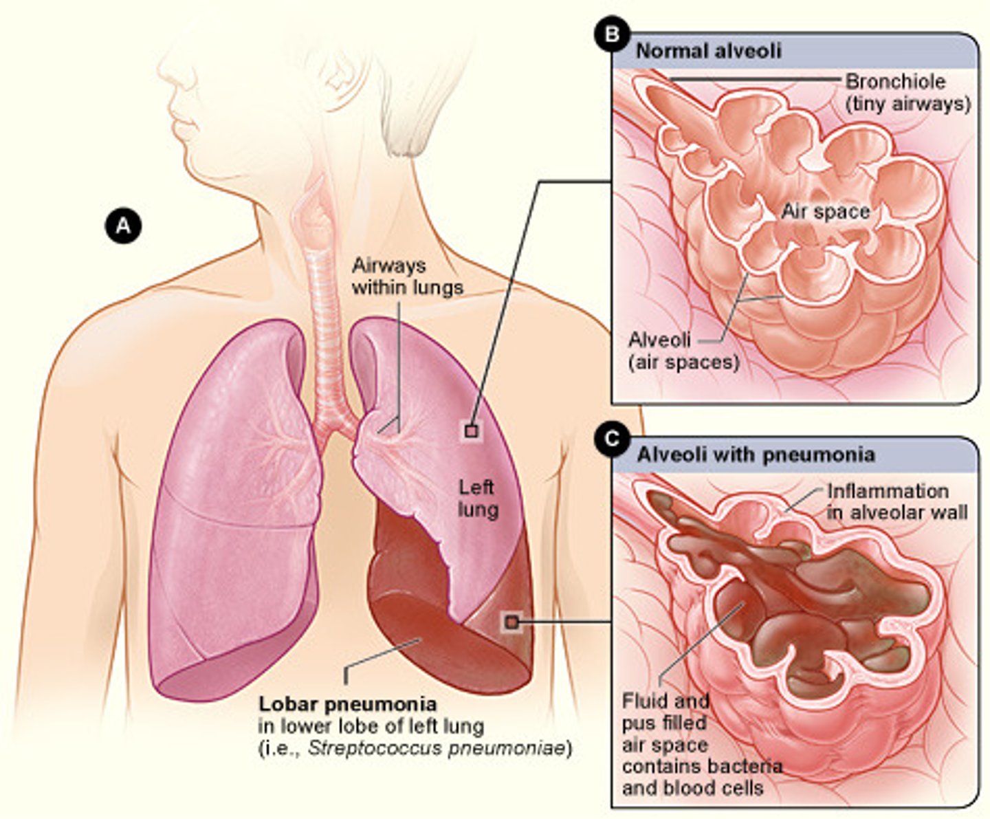 <p>An inflammation of lung tissue, wherer the alveoli in the affected areas fill w/fluid</p>