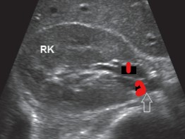<p>Label the structures at the renal hilum. </p><p>(HINT: The structure at the 2 did not have color)</p>
