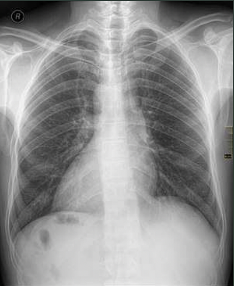<p>What pathology is seen on this x-ray?</p>