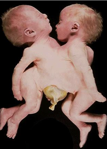 <p>conjoined twins at the chest</p>