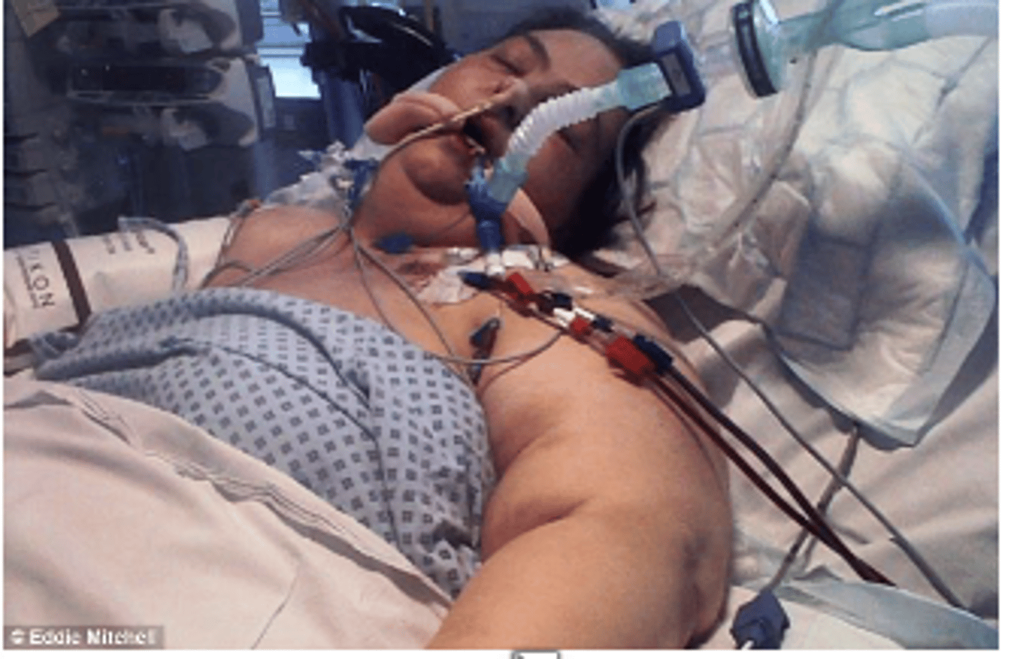 <p>Mother of two children wanted to take her children to Disney World and ride the roller coaster with them. She was morbidly obese and weighed 250 lbs. She had tried numerous diets without success and decided to have a gastric bypass. The surgery went as planned at a well-known bariatric unit and she was discharged three days later. Within a few days of leaving the hospital, she developed abdominal pain and began vomiting. She went to the emergency room of a local hospital and five days later the surgeons drained abdominal fluid from her side. Several days later a hole was found in her stomach lining. She never recovered from this and died. At autopsy, several other wounds were found, and most were only partially healed.</p><p>What caused her death?</p><p>a)Inadequate protein intake</p><p>b)Suboptimal nutrition</p><p>c)Lack of vitamin C</p><p>d)Excess fluid intake</p>