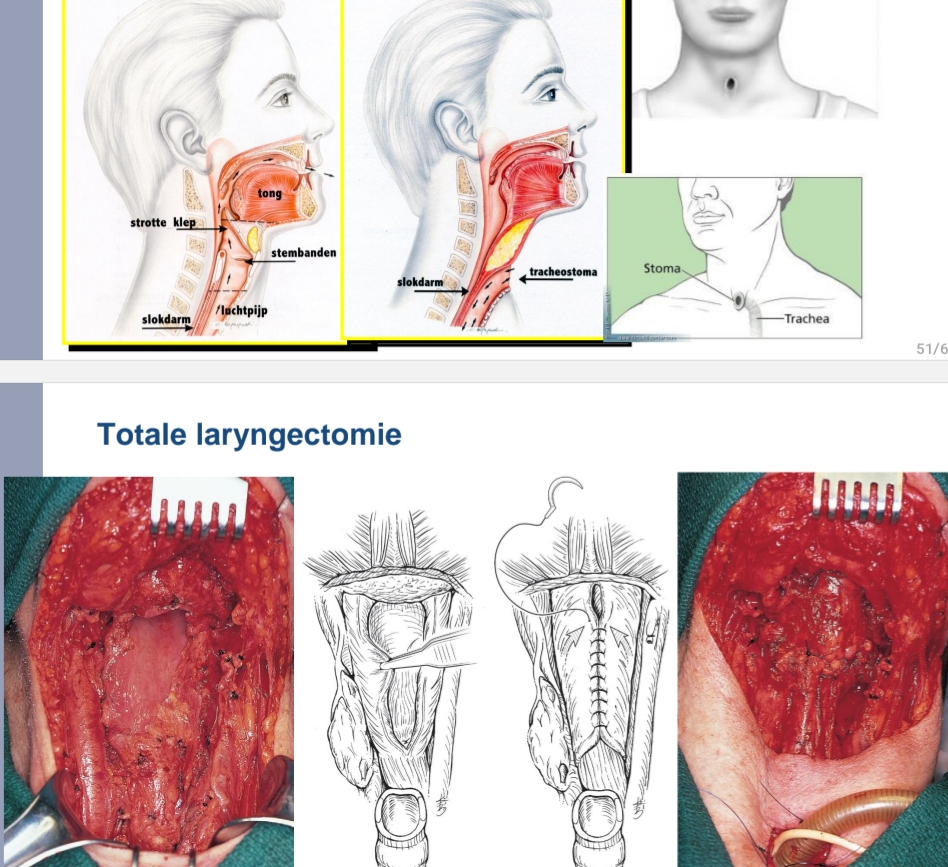 <p>100% aspiratie postoperatief : <br>tracheotomie<br><strong><u>Enkel bij jonge leeftijd; goede <br>algemene toestand</u></strong>; goede preoperatieve slikfunctie en goede <br>pulmonale toestand (dus geen mensne met slikfunctie problemen of ademhalingstelsel)<br>Verticale partiële laryngectomie<br>Klik om het opmaakprofiel van de modelondertitel te bewerken<br>(anterolateraal, frontaal)<br>Horizontale partiële laryngectomie<br>- supraglottisch<br>- supracricoidaal<br>- supratracheaal</p>