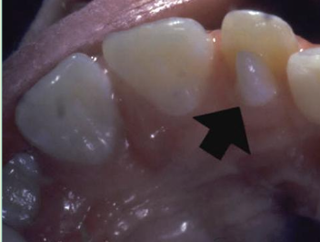 <p>Accessory cusp on<strong> lingual of incisor; </strong>usually<strong> maxillary lateral incisor; </strong>usually has pulp tissue inside</p>