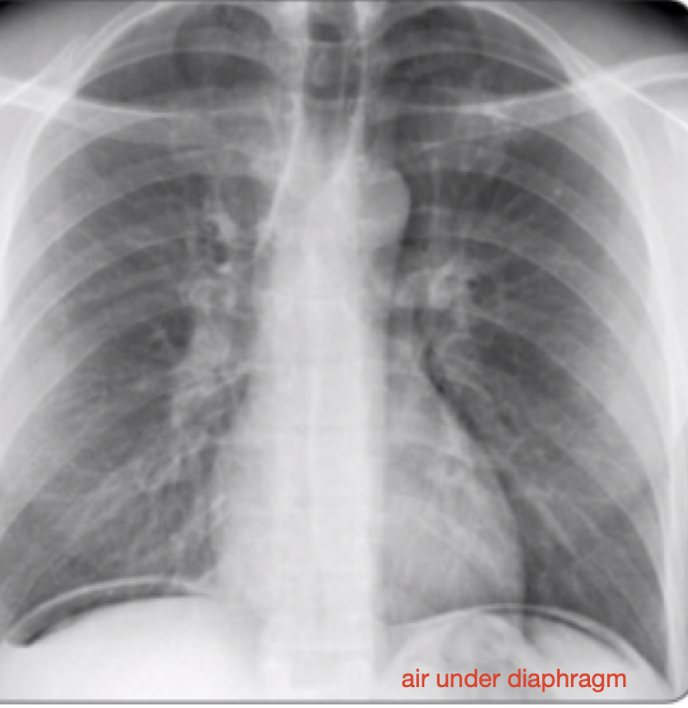 <p><span><strong>full thickness breach in organ, usually intestinal or gastric, </strong></span><br><span>-often <strong>secondary to diverticulitis, appendicitis</strong>, peptic ulcer, trauma, <strong>bowel obstruction,</strong> mesenteric ischemia, foreign body</span></p><p><span>S/S: tachycardia, hypotension, abdominal pain, nausea/vomiting (looks like sepsis/peritoneal signs)</span></p><p><span>Dx: CBC, CMP, PT/INR, blood cultures if septic, CT or XRAY</span></p><p><span>Tx: NPO, IV resuscitate, <strong>broad spectrum antibiotic coverage for suspected GI pathogens, Surgical consultation</strong></span></p>