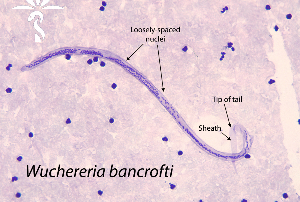 <p>W. bancrofti pathology</p>