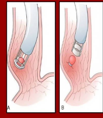 <ul><li><p>“banding of varices”</p></li><li><p>(basically we put a band around the varices, that cuts off the blood flow and then it falls off and dies!)</p></li><li><p><strong>1st line IF patient cannot tolerate or are contraindicated to NSBBs</strong></p><ul><li><p>not really used for small varices, more for medium/large</p></li></ul></li></ul><p></p>