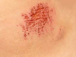scrapes, needs debridement (removal of damaged tissue or foreign objects from a wound)
